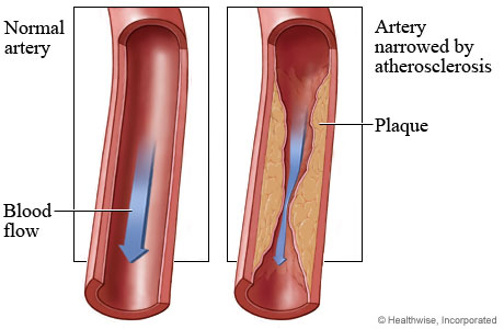 Diagram of arterial plaque